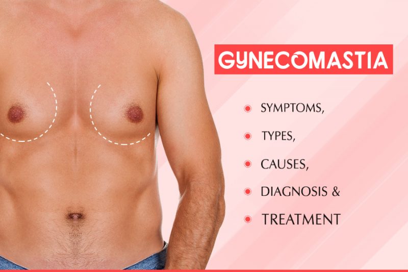 Gynecomastia